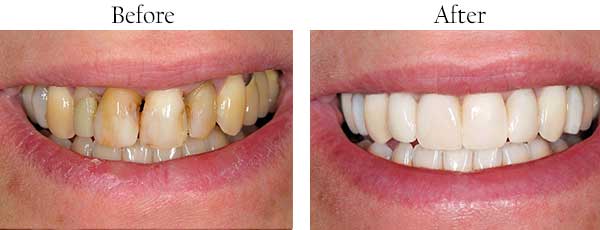 Before and After Teeth Whitening in Bethany