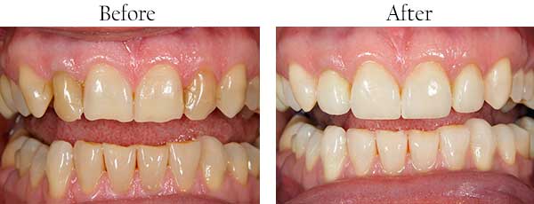 Before and After Dental Implants in Bethany
