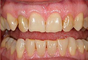 The image shows a close-up of a person s teeth with visible yellowing and staining, which suggests poor oral hygiene or dental issues.