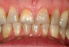 The image shows a close-up view of a person s teeth with visible signs of decay and staining, emphasizing dental health issues.