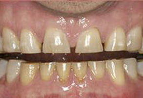 The image shows a close-up of a person s teeth with a yellowish tinge, possibly indicating discoloration or staining, set against a background that appears to be a mouthpiece or dental appliance.